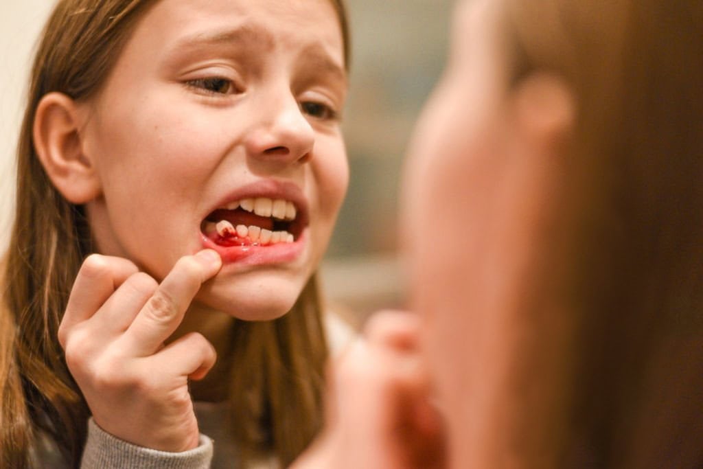 Votre enfant a perdu une dent définitive Pédodontistes Maison de la Dentisterie Pédiatrique du sommeil et de l’interception en Orthodontie